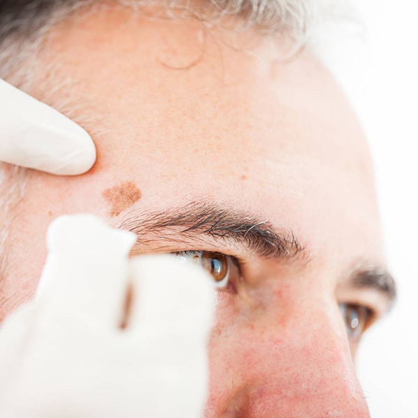 Imagen de refuerzo con trabajador en consulta y carcinoma cutánea visible para la entrada Prevenir el cáncer de piel.